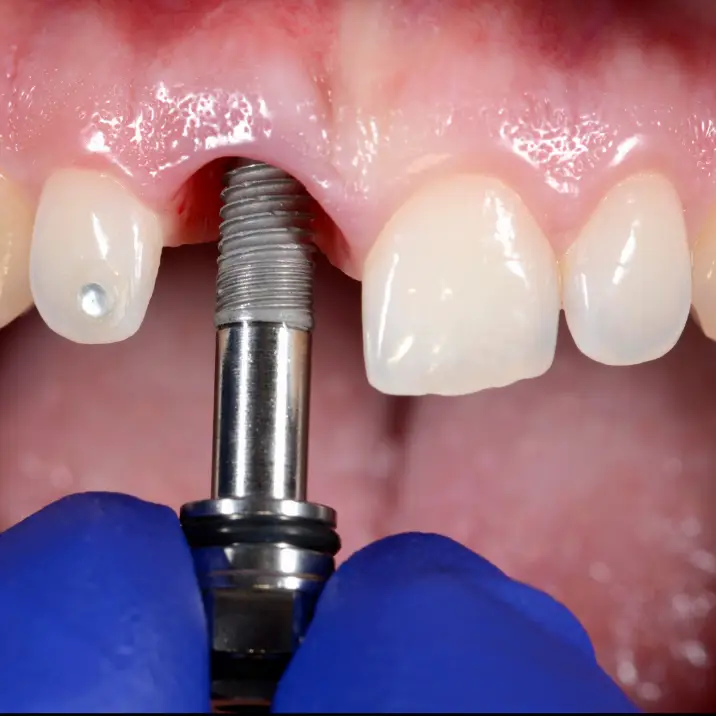Single tooth dental implant
