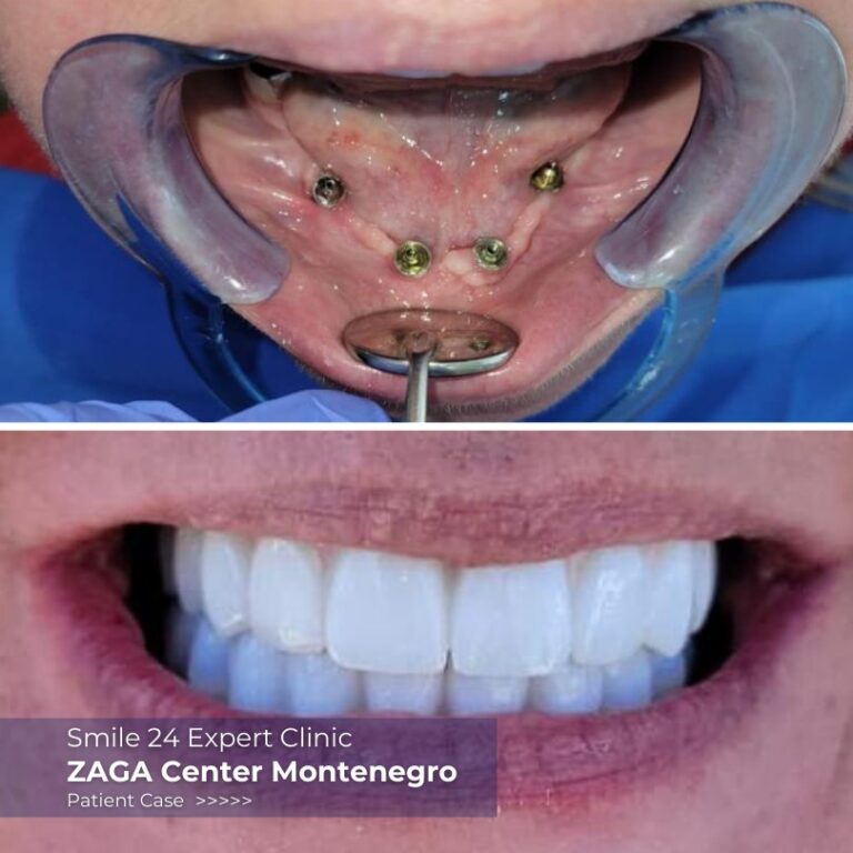 antes despues de la dentadura postiza