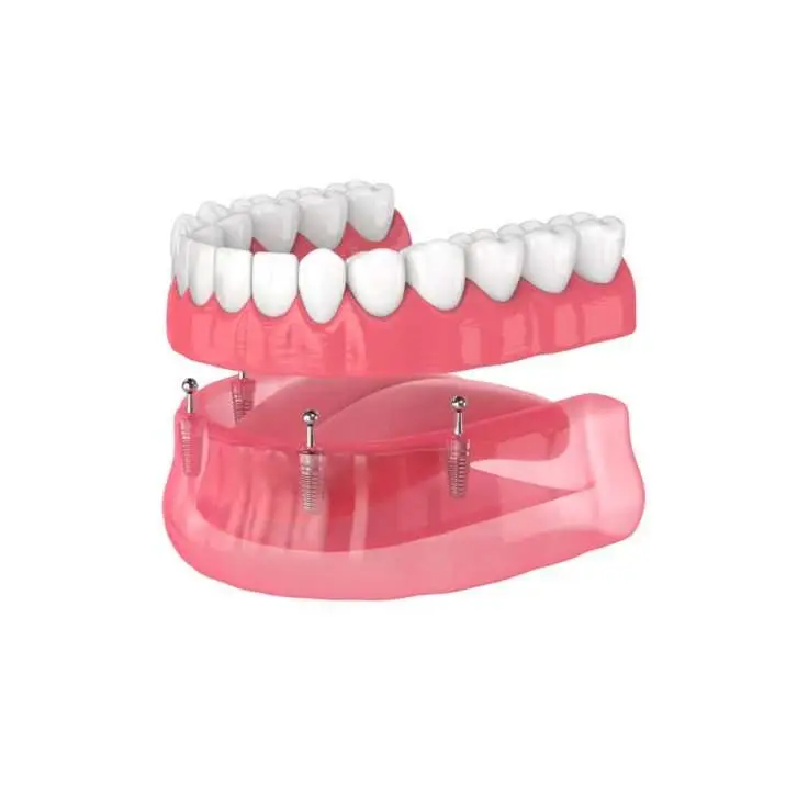 Fixed-dentures-schematic