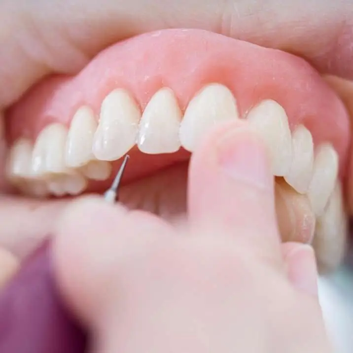 dental implants alternative