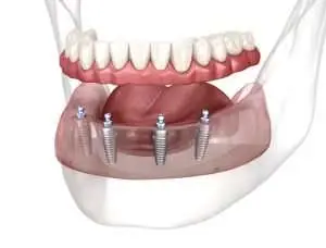 Dental Prosthesis