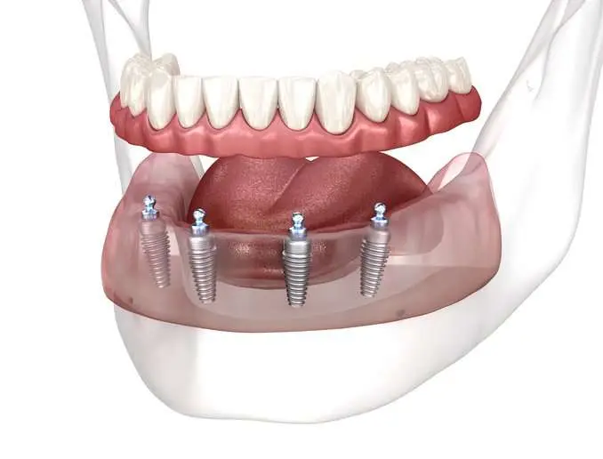 Dental Prosthesis