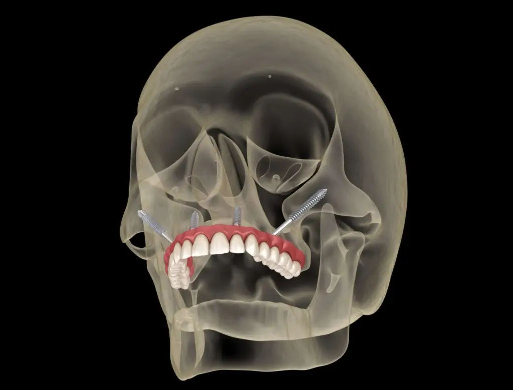 Maxillary Prosthesis Zygomatic Implants