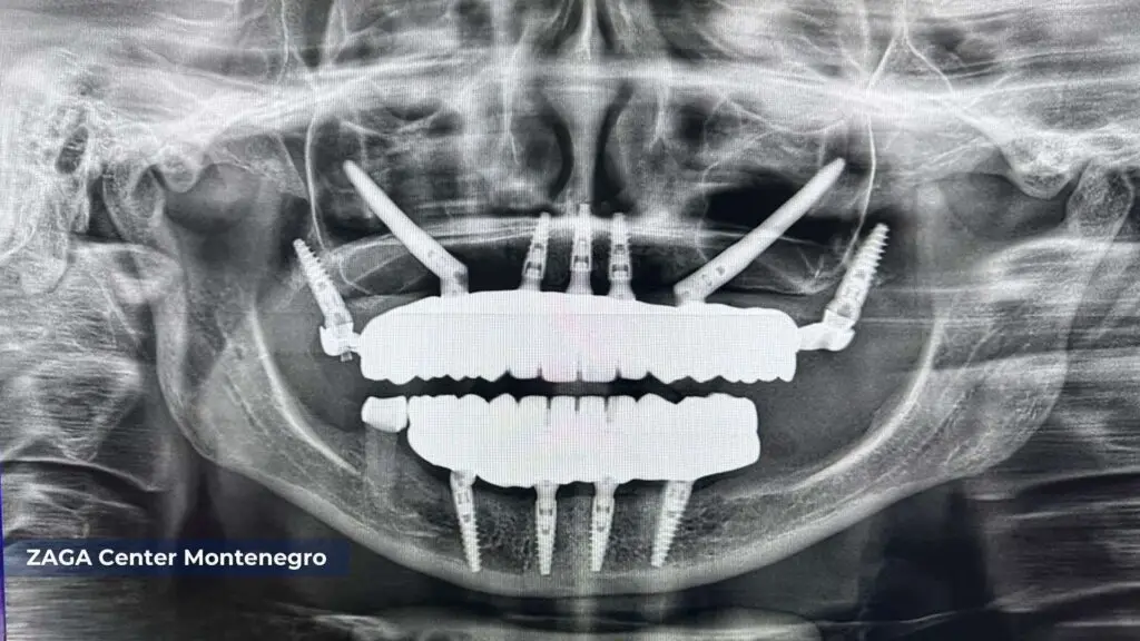 XRay Zygomatic Rehabilitation