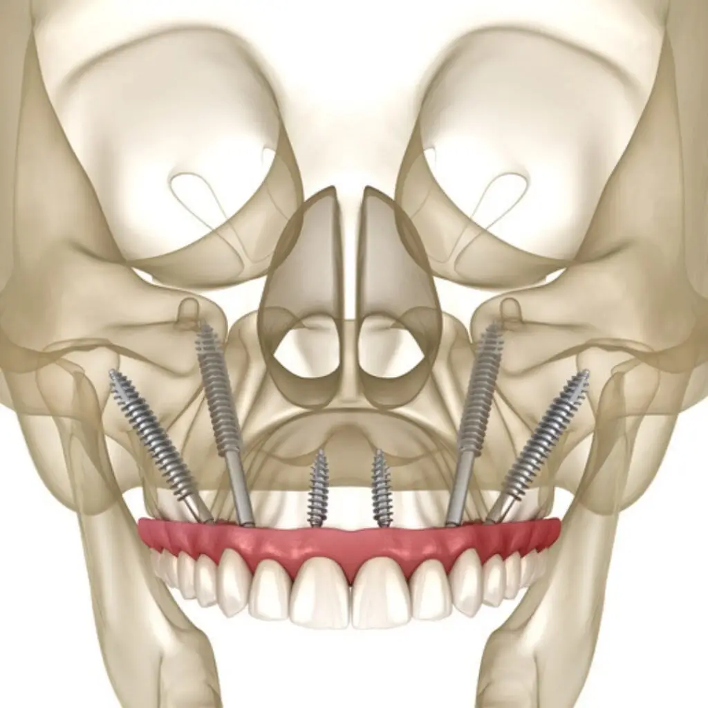zygomatic 3d view