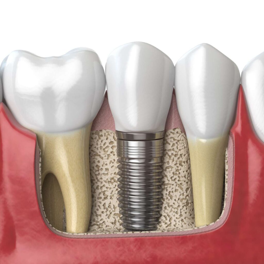 Anatomie implant dentaire
