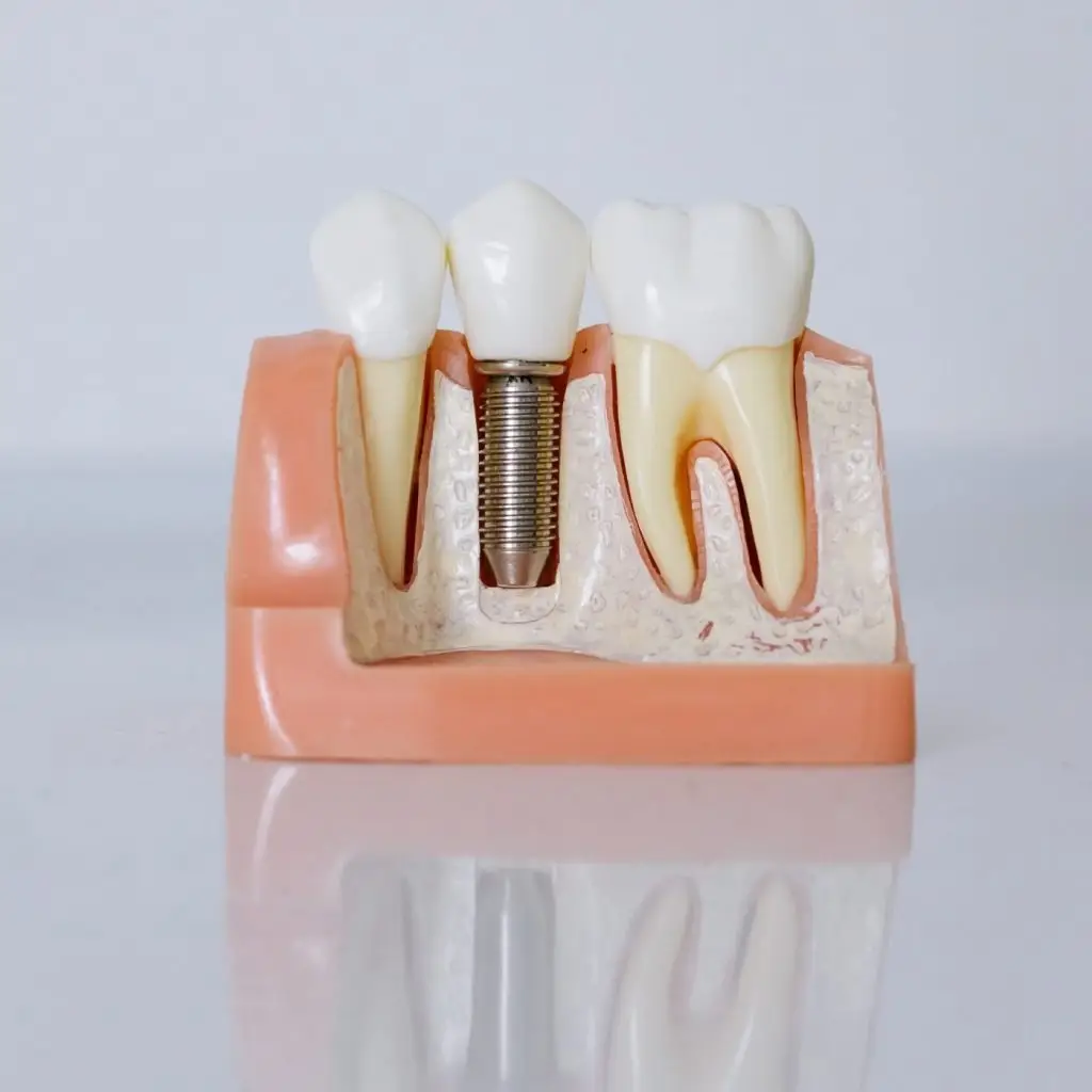 Implant Schematic