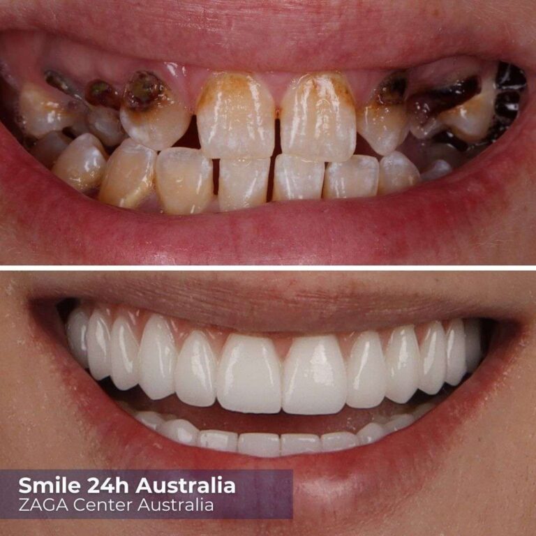 Prima Dopo gli impianti in Australia