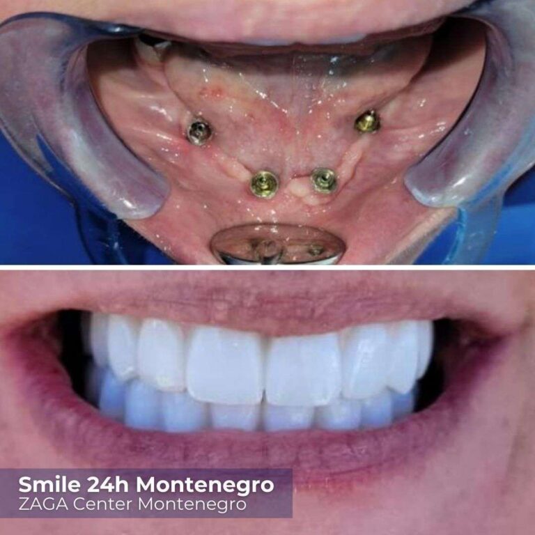 Prima Dopo Montenegro
