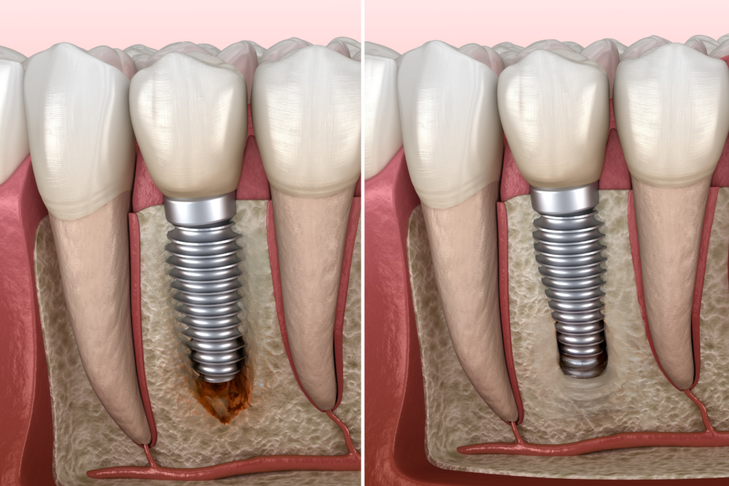 Implant osseointegrat în maxilar. Imagine explicativă