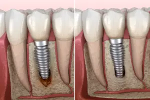 Osseointegrated implant in jaw. Explanation image