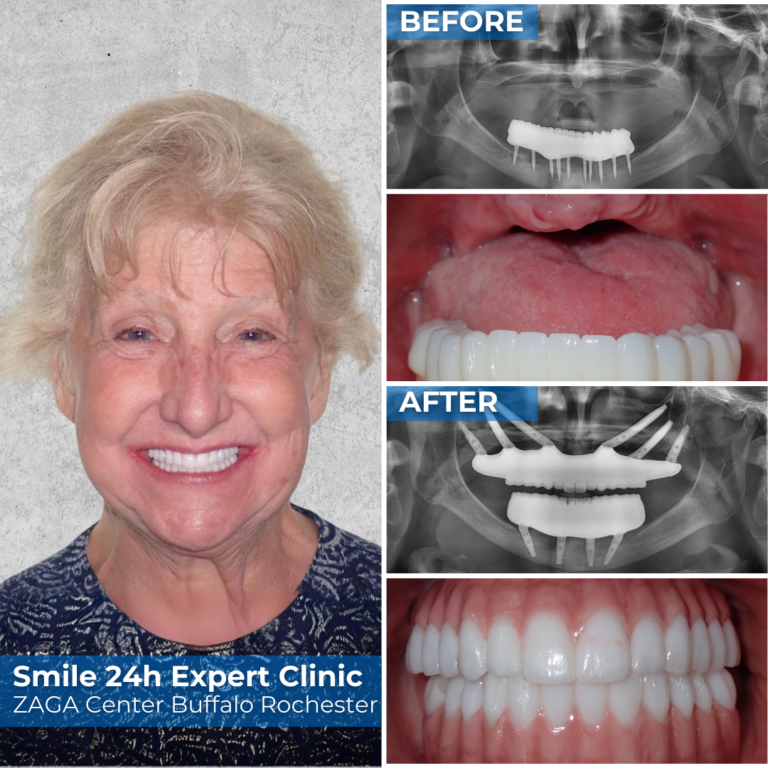 Smile24h 水牛城罗切斯特专家诊所 - 成功案例