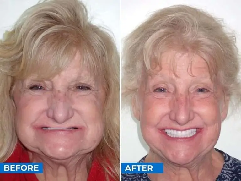 before and after dental implants