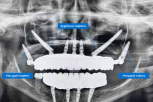 Implants dentaires ptérygoïdiens et zygomatiques dans un traitement de réhabilitation complète