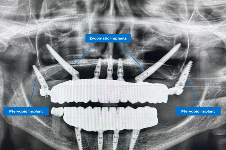 Pterygoid and Zygomatic dental implants on a Full-mouth-rehabilitation treatment