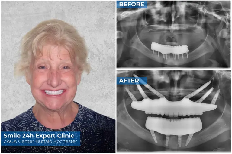Patient before and after dental implants picture