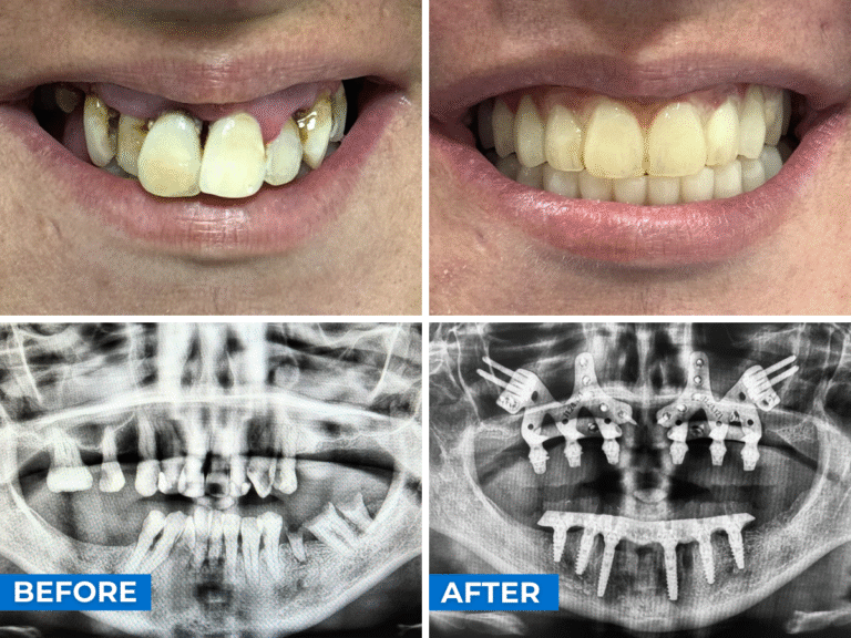 Impianti dentali subperiostei Caso 1