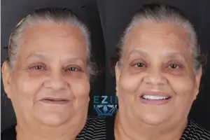 ZAGA Center Cairo Success Story with Zygomatic Implants - before and after picture