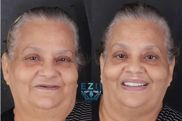 ZAGA Center Cairo Success Story with Zygomatic Implants - before and after picture