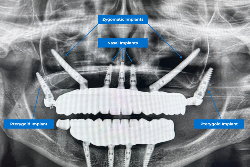różne rodzaje implantów dentystycznych: implanty nosowe, implanty jarzmowe i implanty pterygoidalne