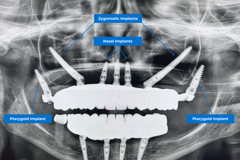 différents types d'implants dentaires : implants nasaux, implants zygomatiques et implants ptérygoïdiens