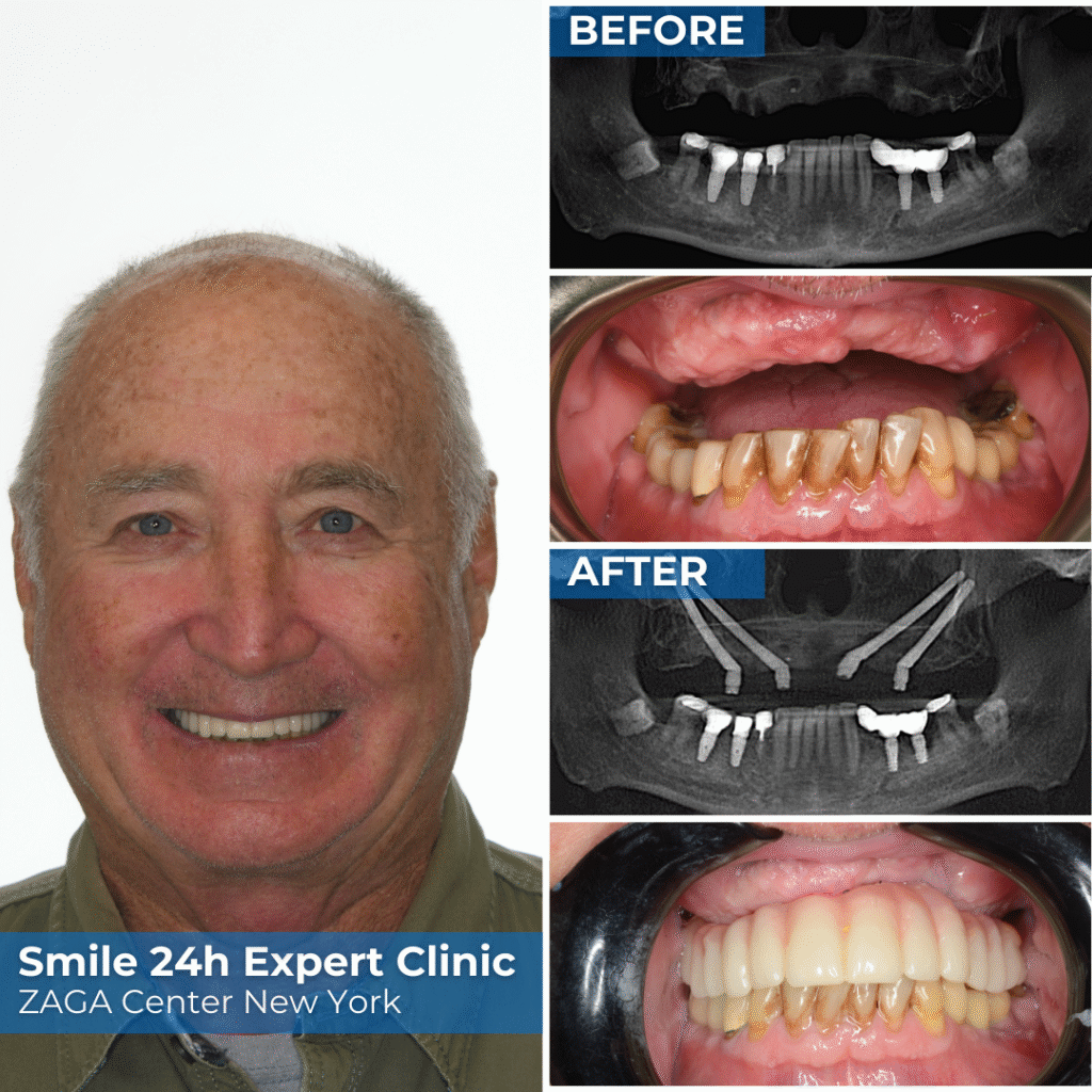 Osobista historia Bruce'a Collemana - implanty dentystyczne przed i po