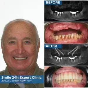 Bruce Colleman personal story - dental implants before and after