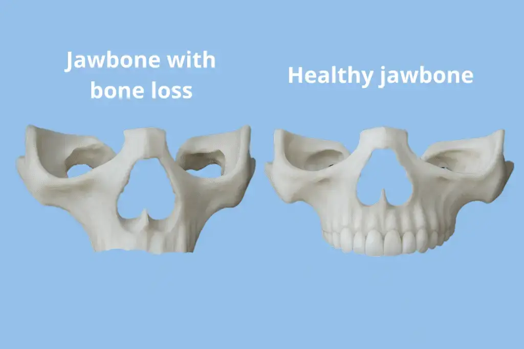Tandheelkundige 3D-modellen van een atrofische bovenkaak versus een gezond kaakbot