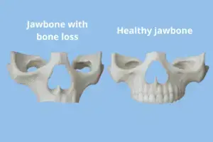 Dental 3D models representing an atrophic maxilla vs a healthy jawbone