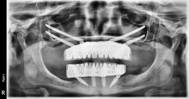 Scanner de Melek après la pose des implants dentaires