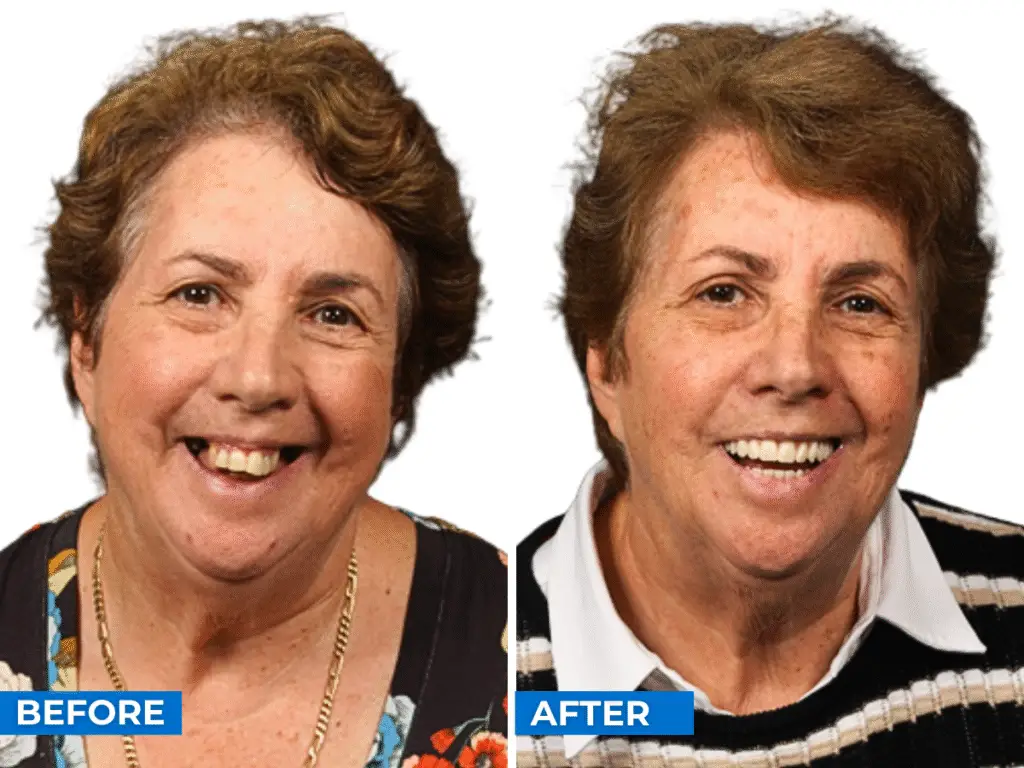 Smile 24h Melbourne Patient Case of Patient Transformation 1