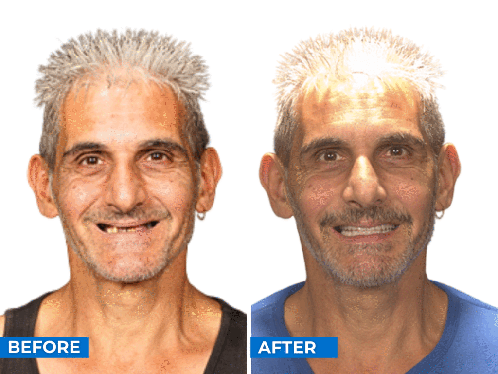 Smile 24h Melbourne Patient Case of Patient Transformation 3