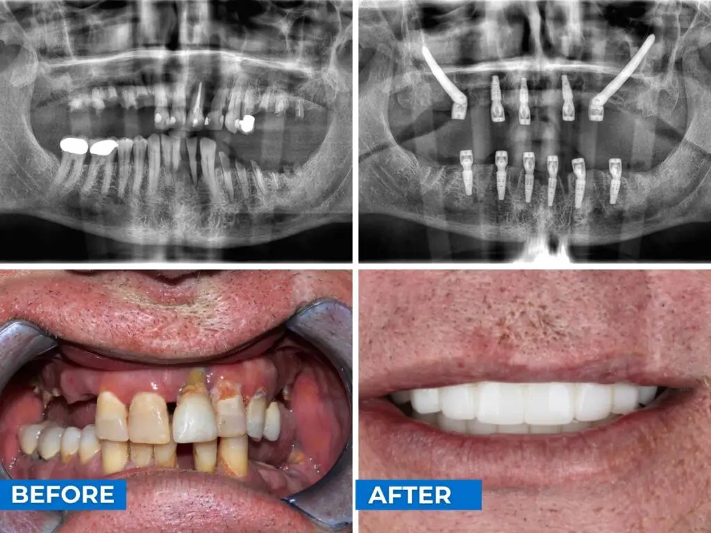 Smile 24h Cancun Patient Case of Patient Transformation 2