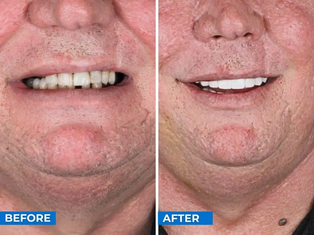 Smile 24h Cancun Patient Case of Patient